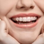 Descubre qué aparato de ortodoncia es perfecto para tu sonrisa