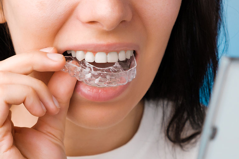 Clínica Dental Bousoño Vargas. Invisalign, la ortodoncia para adultos. Nunca es tarde para ti