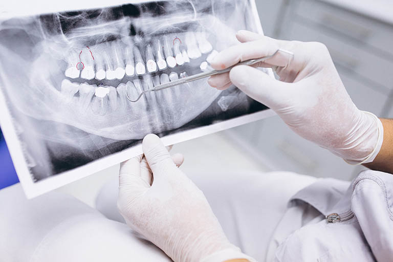 Clínica Dental Bousoño Vargas. Causas y signos de fallo de los implantes dentales