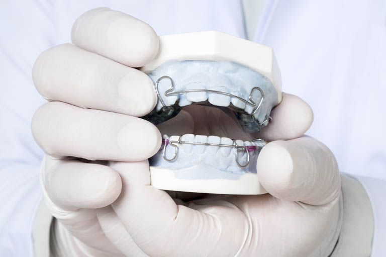 retenedor dental segundo tratamiento de ortodoncia en Oviedo, Bousoño Vargas