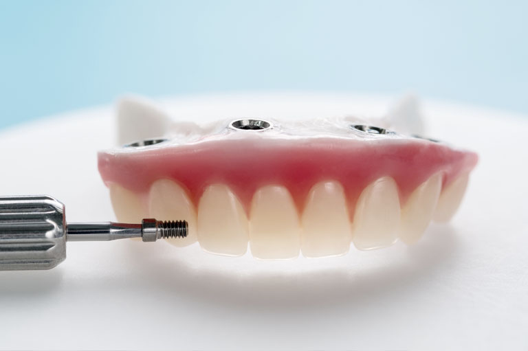Opciones de implantes dentales en Oviedo. Técnica all on 4 en clínica dental Bousoño Vargas
