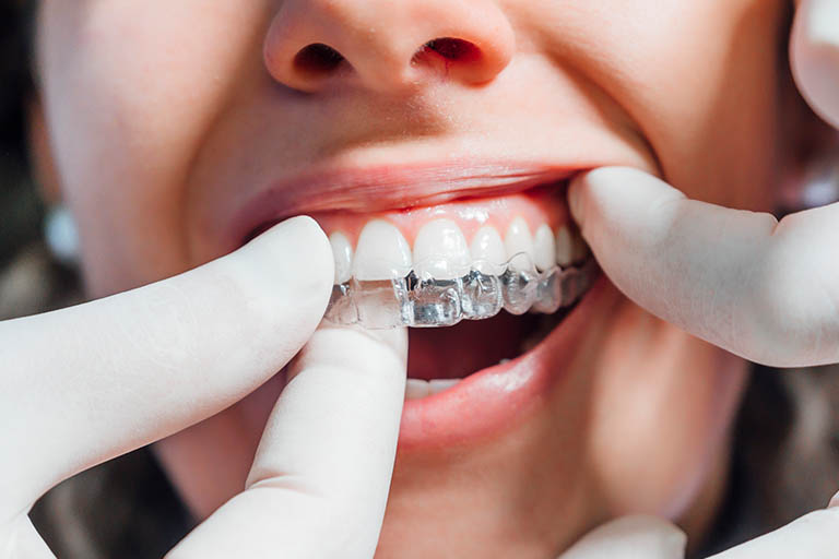 Mujer alinea sus dientes sin molestias con un tratamiento Invisalign de Bousoño Vargas