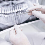 Tratamiento de implantes dentales para que un paciente de Bousoño Vargas recupere la sonrisa