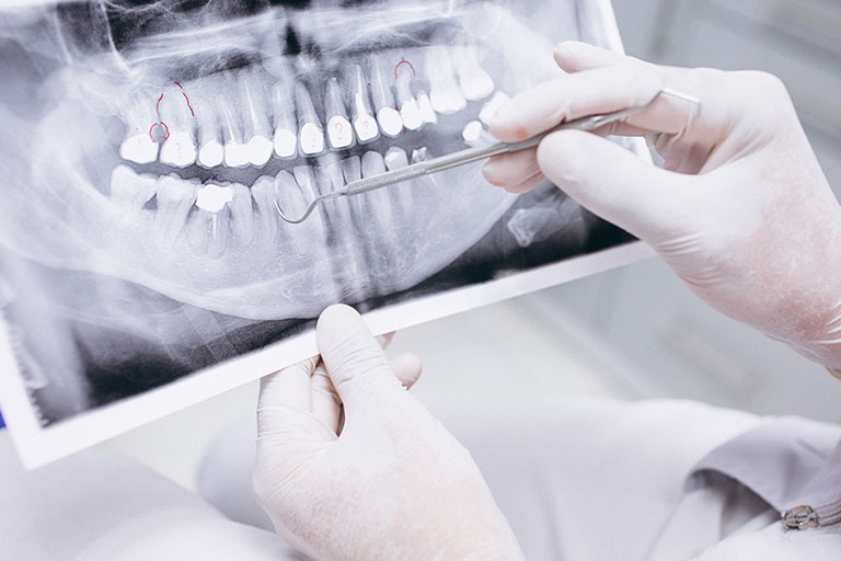 Tratamiento de implantes dentales para que un paciente de Bousoño Vargas recupere la sonrisa