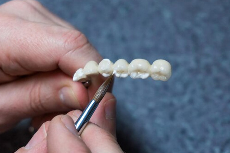 Clínica Dental Bousoño Vargas. Puentes dentales o prótesis. Implantes dentales en Oviedo