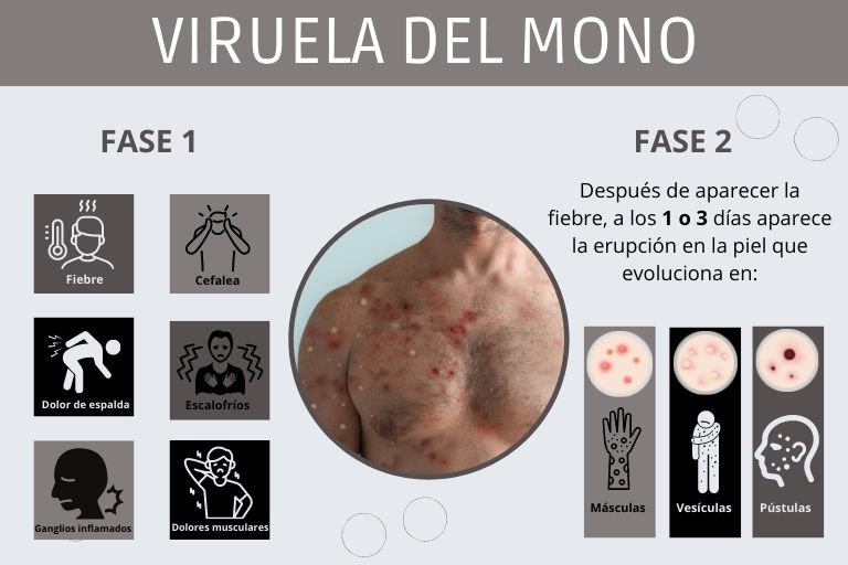 La viruela del mono y sus efectos en la salud bucal. Clínica Dental Bousoño Vargas, Dentista en Oviedo.