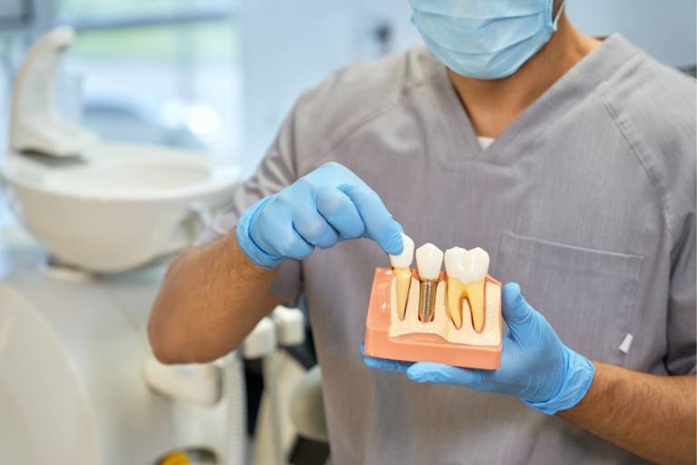 ¿Cómo se adaptan los implantes dentales al cuerpo?